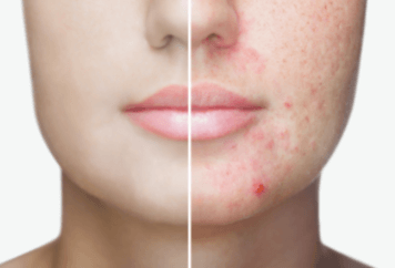 Tratamento da acne secundária à testosterona